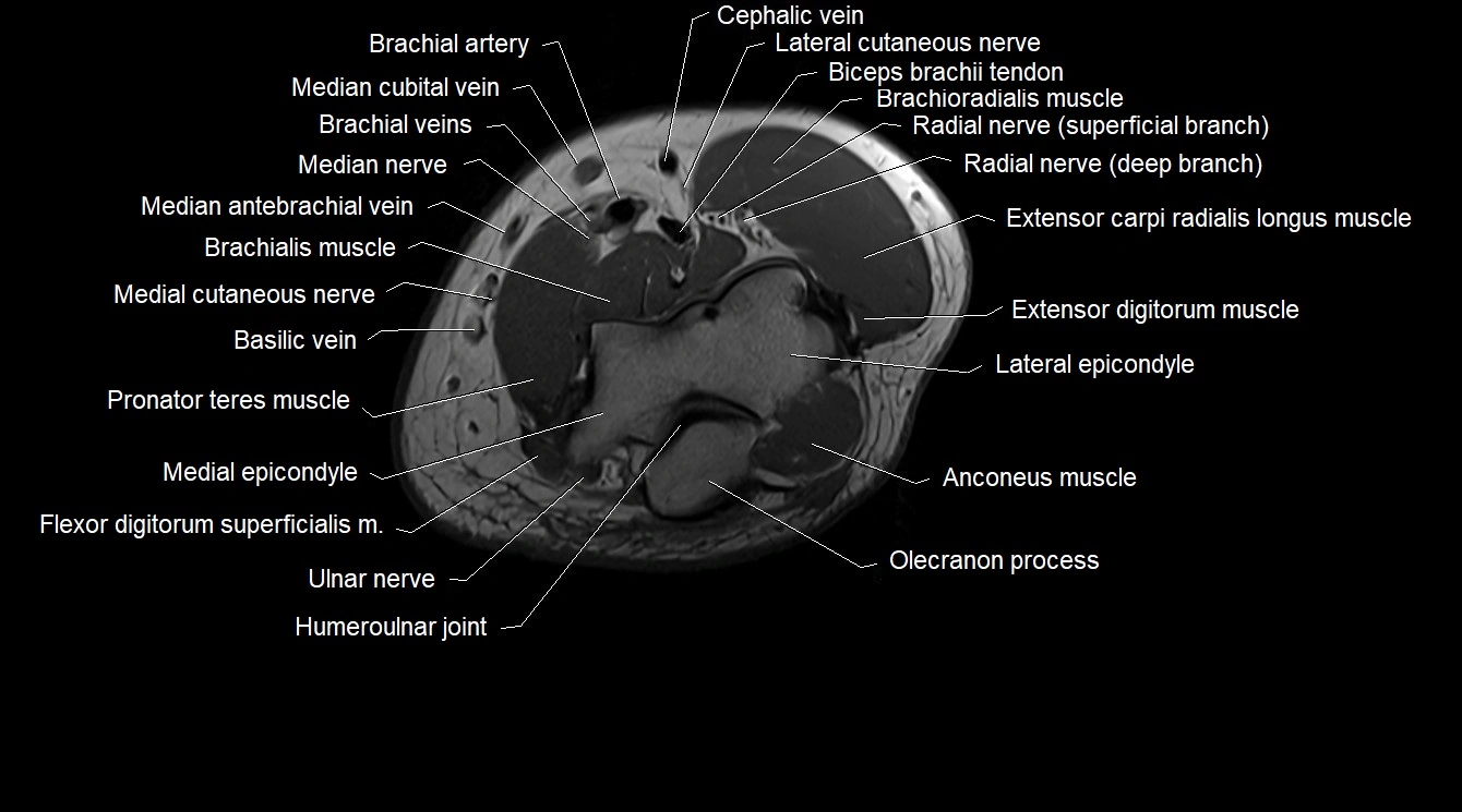 Upper arm( humerus) cross section anatomy MRI 3T axial image 55.webp